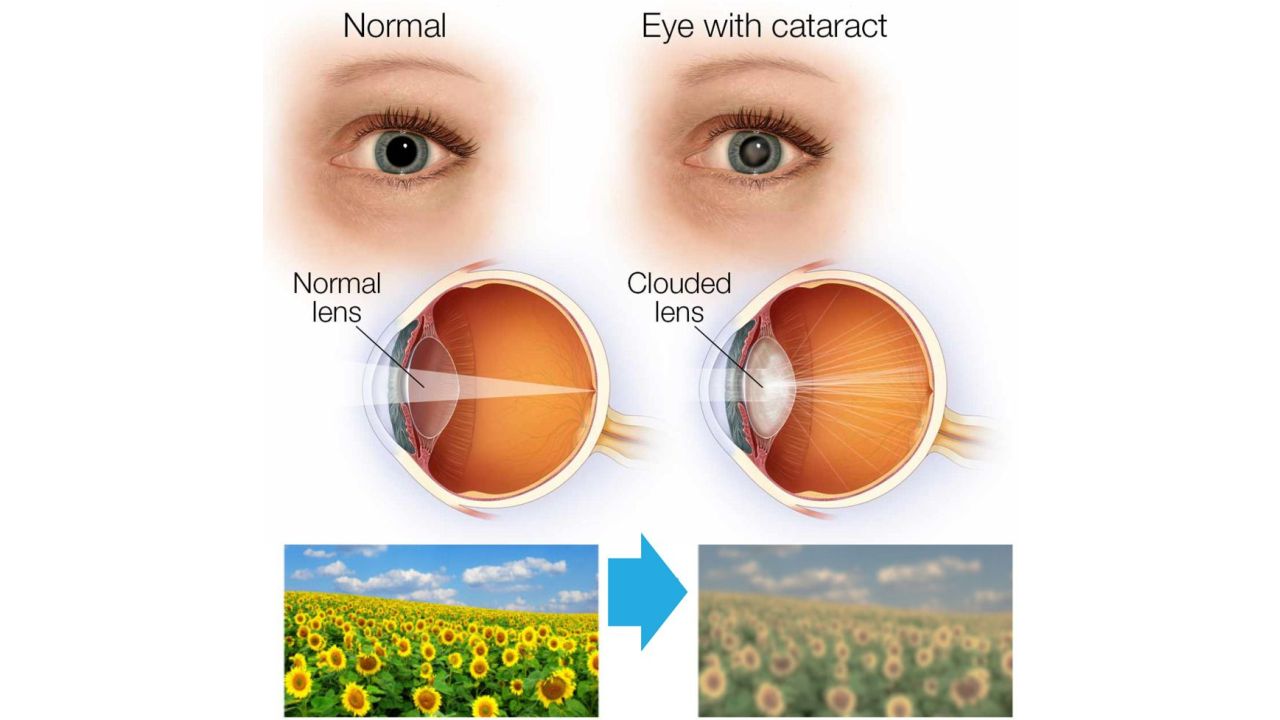 cataract view